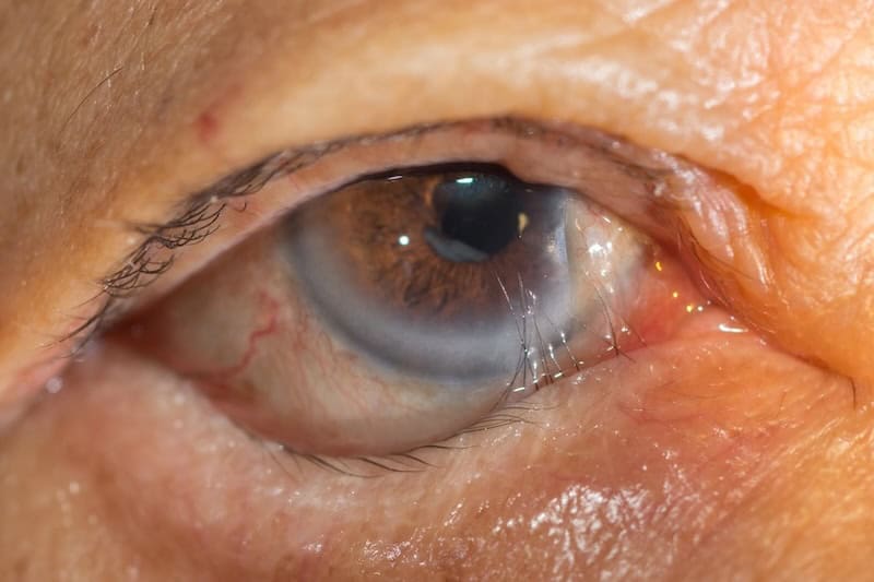 eyelid entropion surgery
