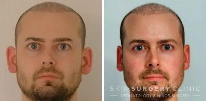 Otoplasty prominent ear correction surgery before and after