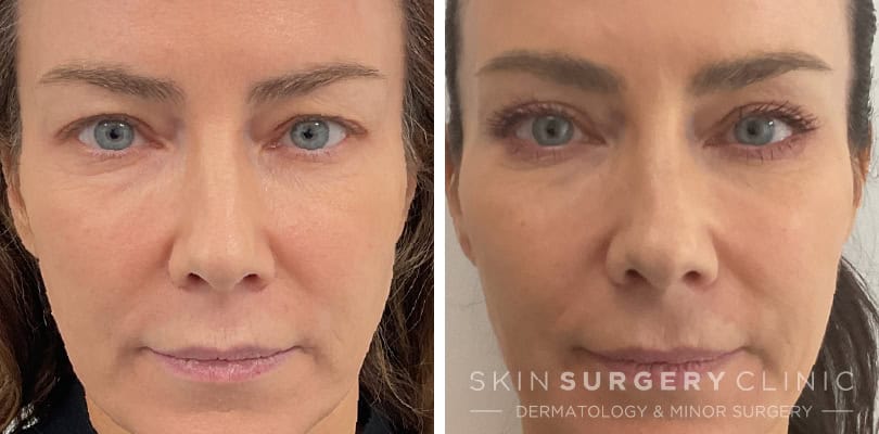 Eyelid Surgery by Upper Blepharoplasty in Bradford Upper Blepharoplasty before and after pictures
