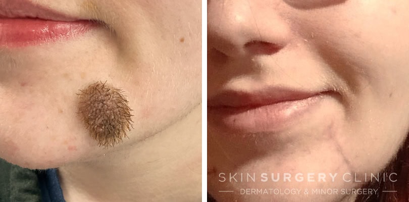 Surgical Skin Lesion Removal in Leeds Surgical Skin Lesion Removal in Leeds