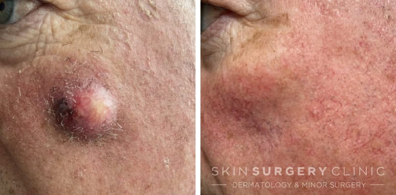 Cyst Removal Newcastle Sebaceous Cyst Removal in Newcastle before and after