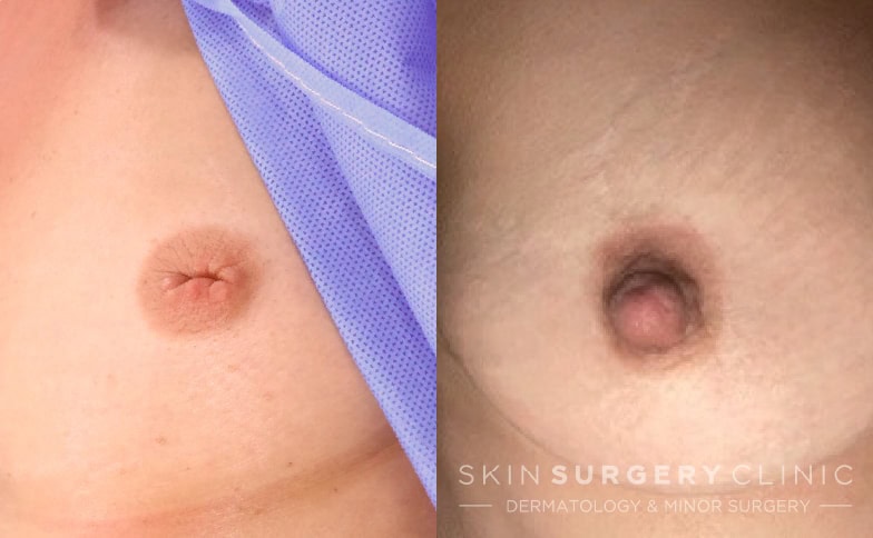 Inverted-Nipple-Surgery-v2