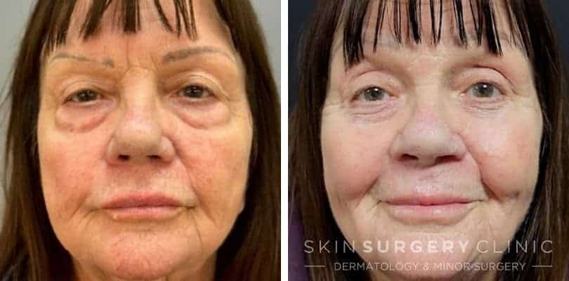 Lower Blepharoplasty Eyelid Surgery in Newcastle - before and after