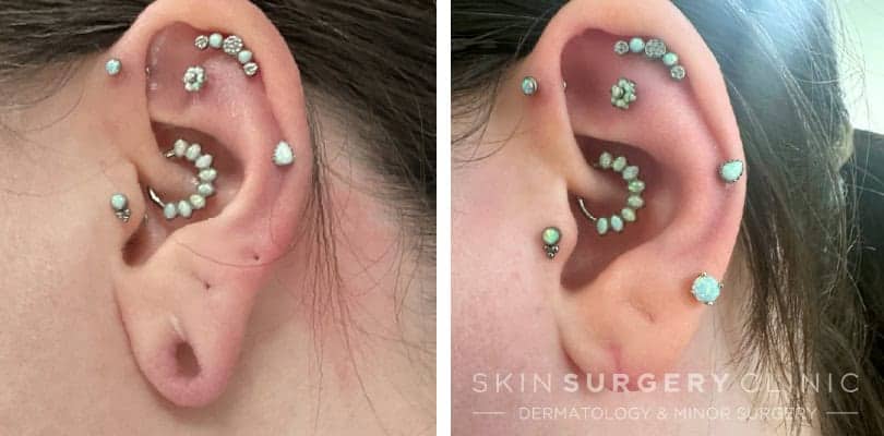 Stretched Earlobe Reconstruction in Newcastle - before and after