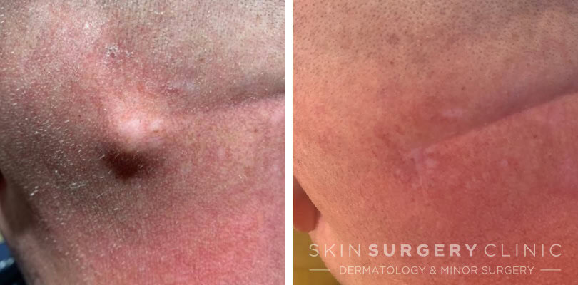 Sebaceous Cyst Removal Leeds