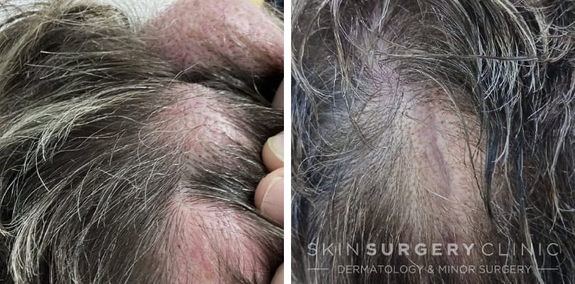 Sebaceous Cyst Removal Leeds