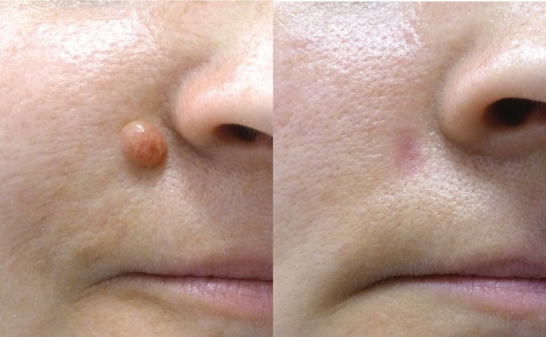 mole-removal-banner-right