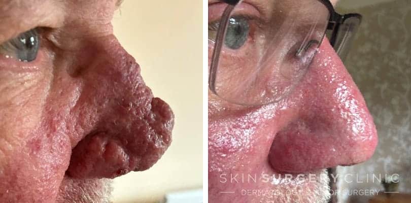 Rhinophyma Treatment Leeds and Bradford Rhinophyma Treatment Leeds and Bradford before and after pictures