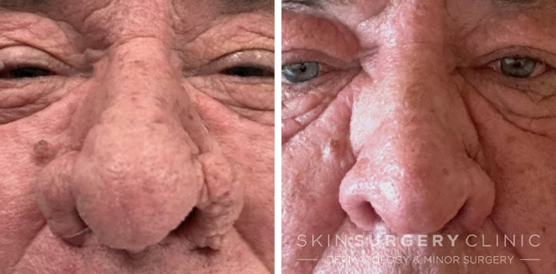 Rhinophyma Treatment Leeds and Bradford Rhinophyma Treatment Leeds and Bradford before and after pictures