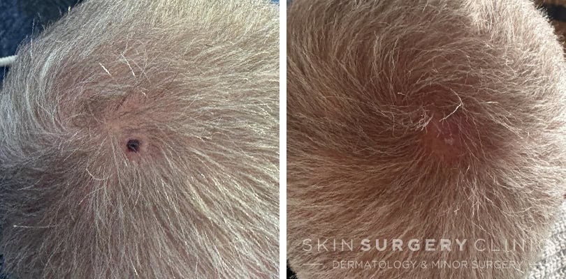 skin cancer treatment IB patient story skin cancer treatment IB patient story