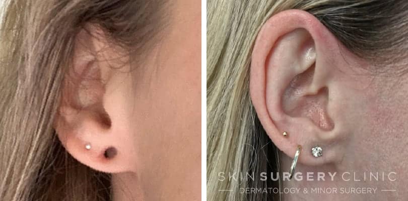 Stretched Earlobe Reconstruction