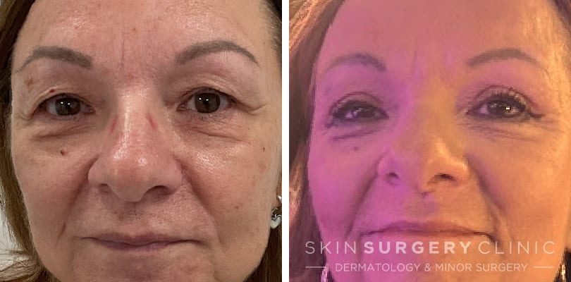 upper blepharoplasty jeanette logan before and after Upper Blepharoplasty Before and After