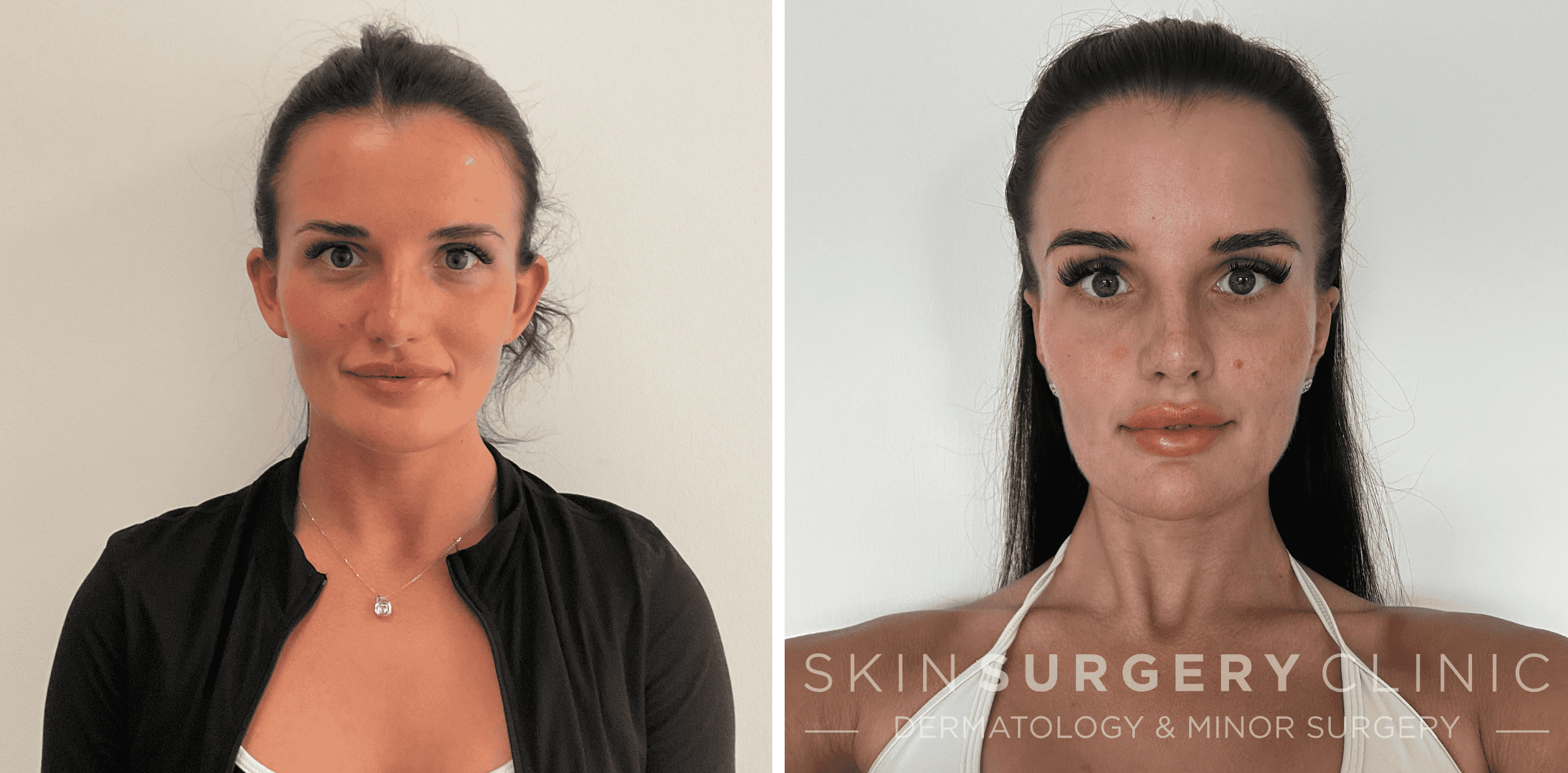 Otoplasty prominent ear correction surgery before and after Otoplasty prominent ear correction surgery before and after