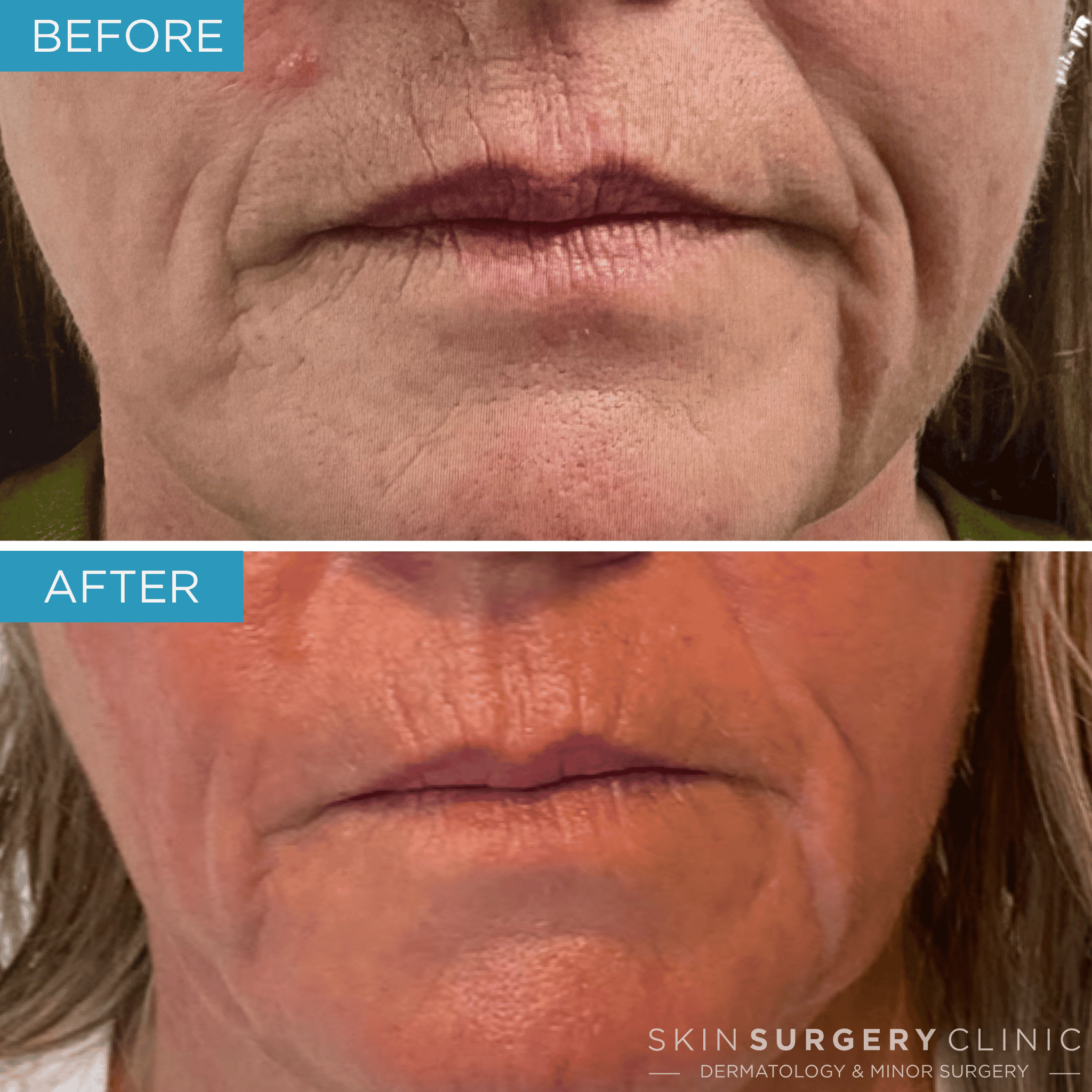 Laser-Skin-Resurfacing-before-and-after-SY Laser-Skin-Resurfacing-before-and-after-SY