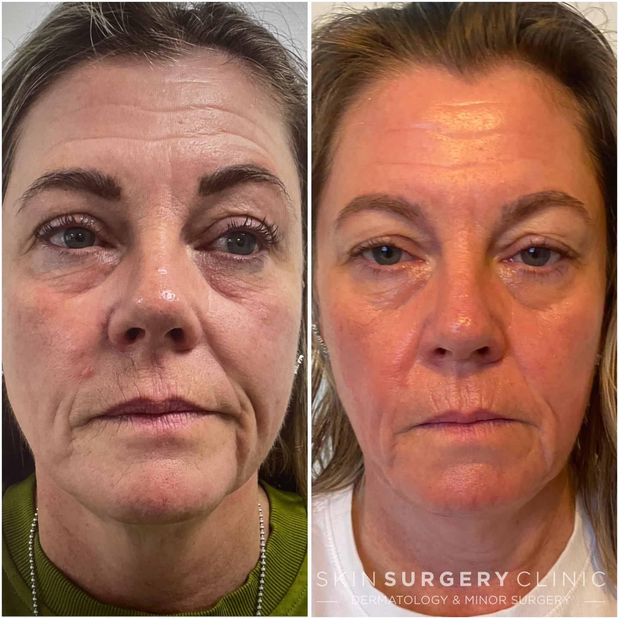 Laser skin resurfacing before and after Laser skin resurfacing before and after