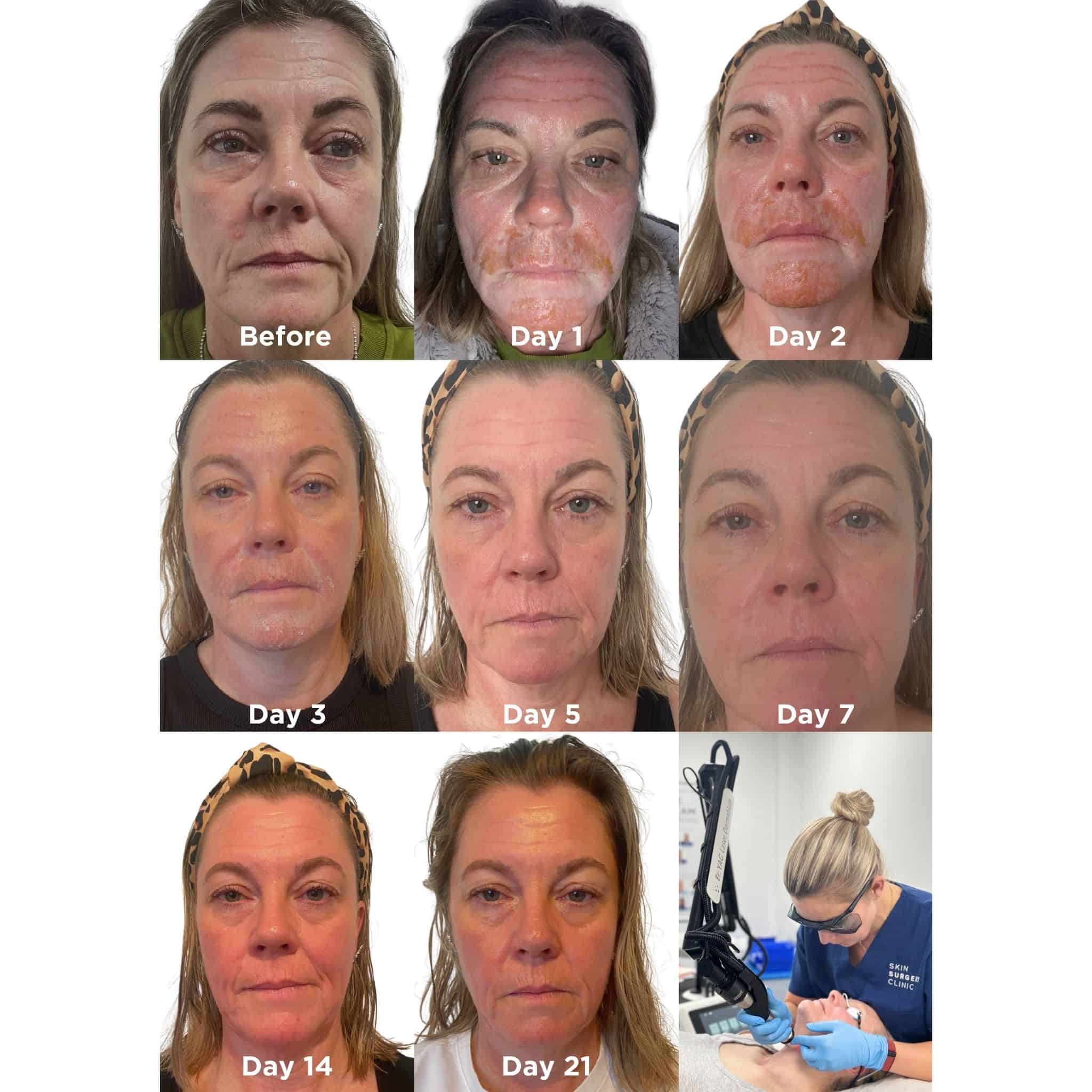 Laser skin resurfacing recovery Laser skin resurfacing recovery