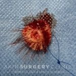 The Lesion