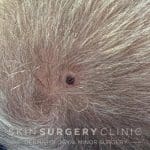 Before Surgery