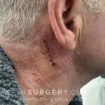 After Surgery