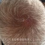 12 Weeks Post Surgery 