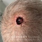 14 Days Post Surgery
