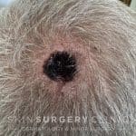 7 Days Post Surgery