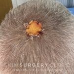 Immediately After Surgery 