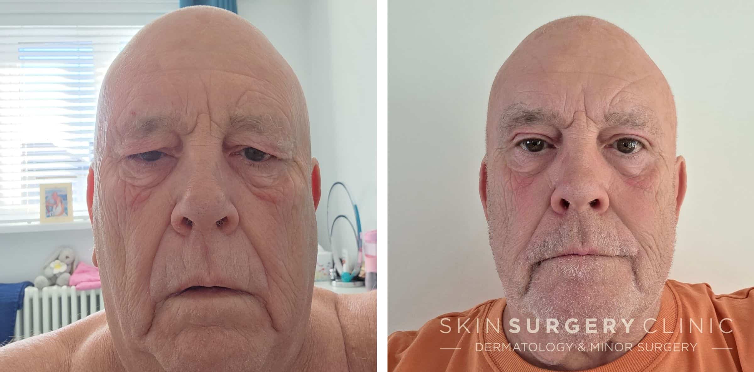 Upper Blepharoplasty Eyelid Lift in Newcastle Upper Blepharoplasty Newcastle before and after pictures