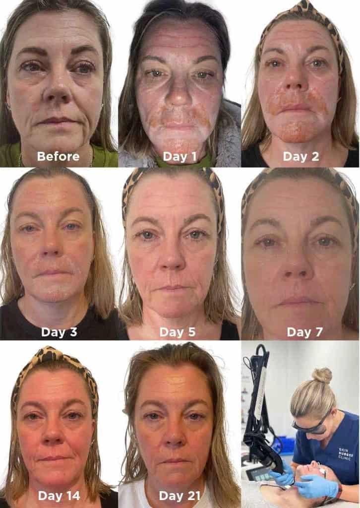 Laser-Skin-Resurfacing-Gallery Laser Skin Resurfacing